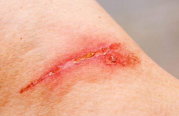BF-6 can not be used to treat festering wounds